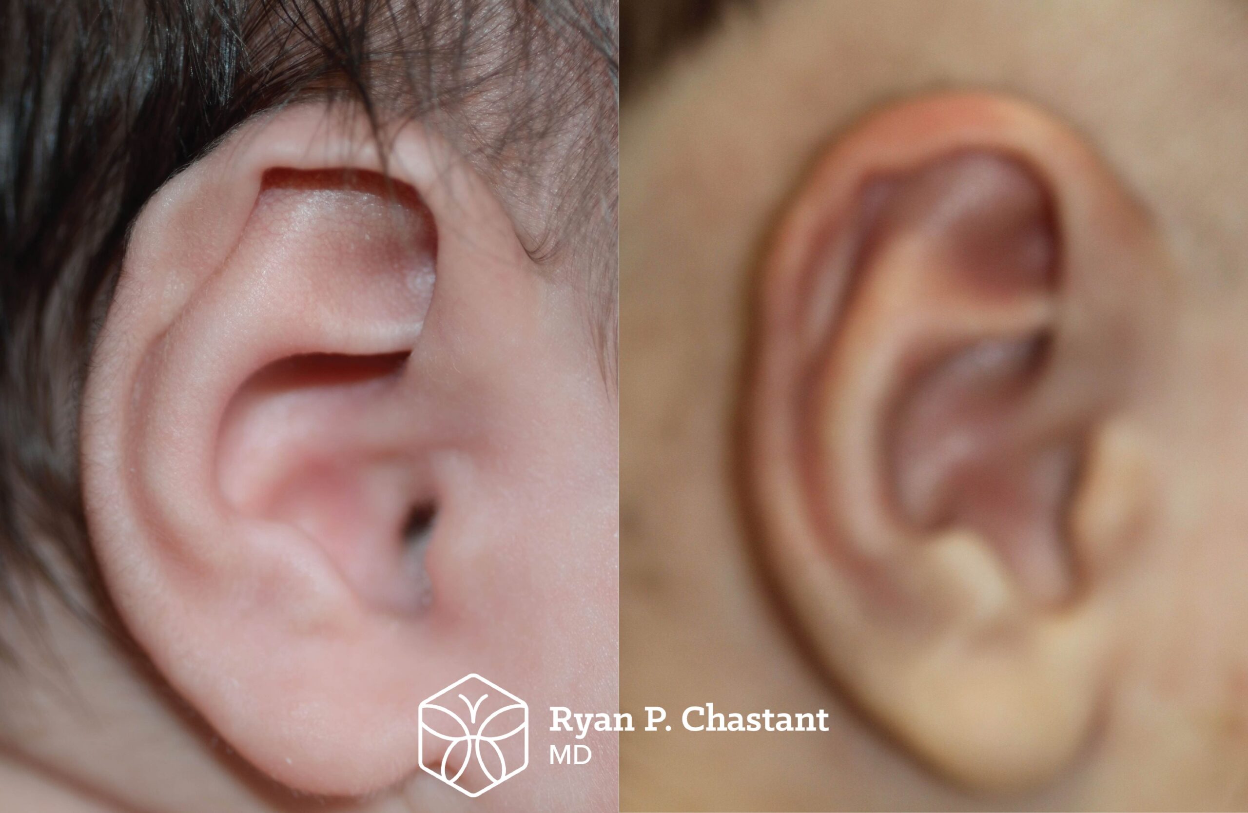 Before and after, 1 mo old- right ear well (1)