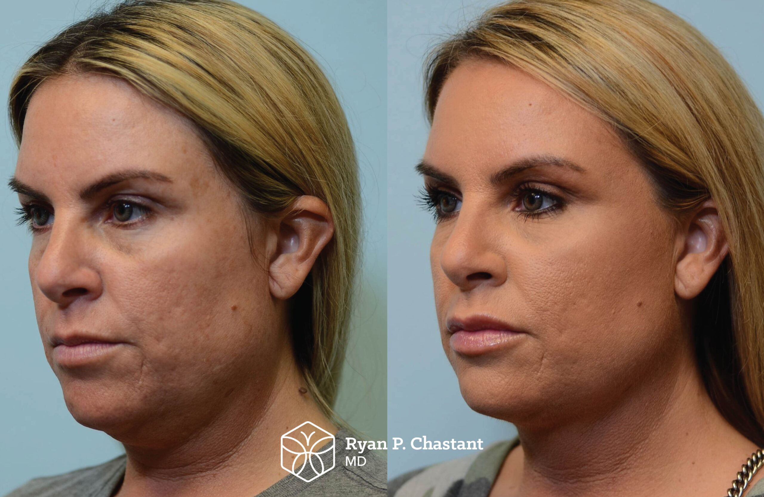 Before and after, 43yo female- Left oblique