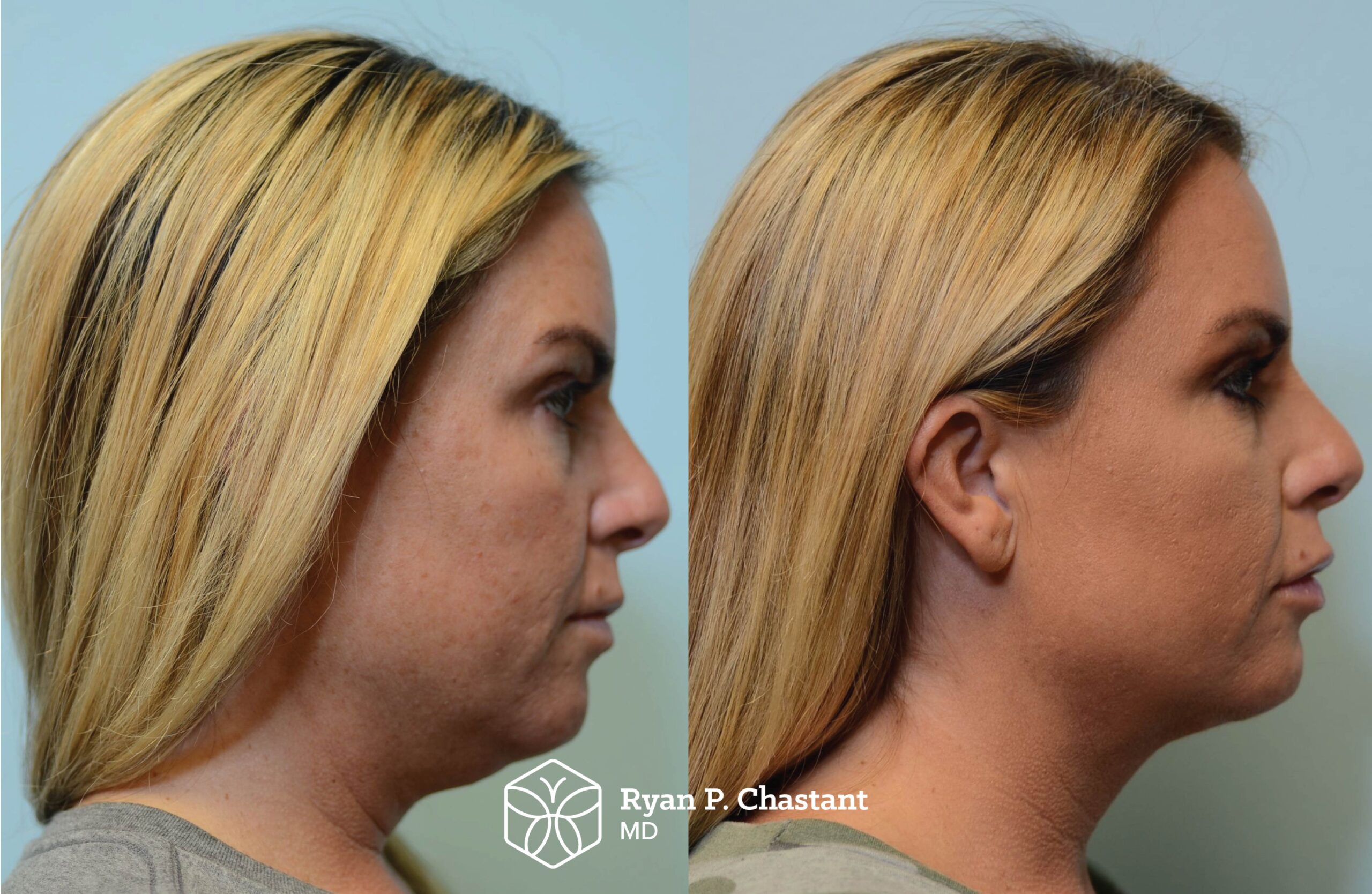 Before and after, 43yo female- Right side view